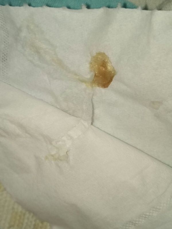 早晨起来打喷嚏流清鼻涕,一只鼻孔里只有清鼻涕,不鼻塞;另一只鼻孔里