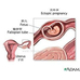 宫外孕流产