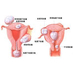 浆膜下子宫肌瘤