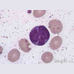 T细胞淋巴瘤