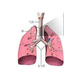 肺腺癌