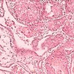 宫颈鳞状细胞癌