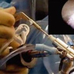 椎间孔镜髓核摘除术