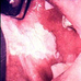 口腔粘膜白斑病
