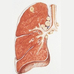 浸润型肺结核