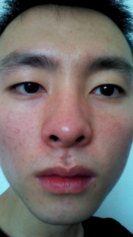 脸上皮肤很脏很红鼻子上也有很多黑色的点,挤出来的东