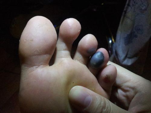 血泡怎么处理,要多久才能好