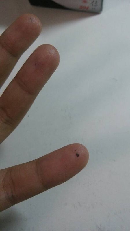 前几天，小手指被伞收伞时夹了一下就有点死血了，本以为会好结果好久了都没好，怎么办?