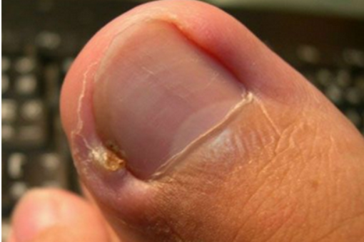 甲骨炎具体是怎样形成的?