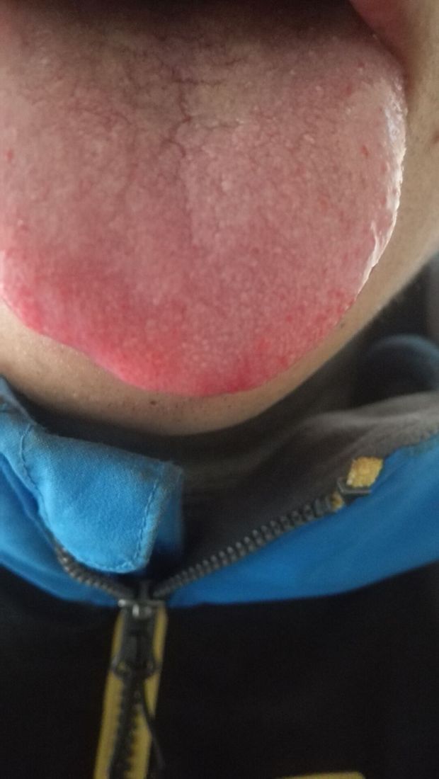 正常的舌苔应该