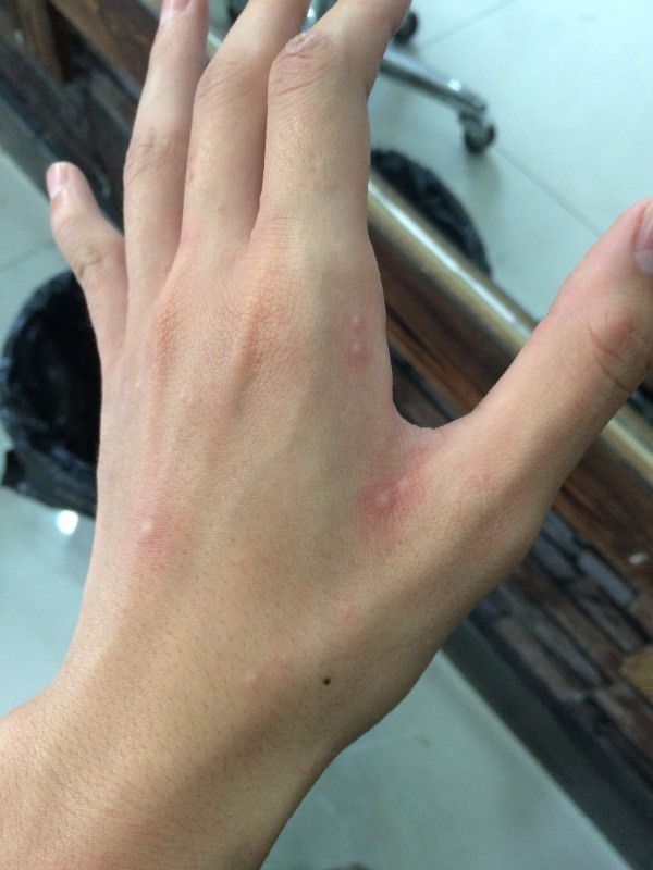 手背上起的这些痘痘是什么啊该怎么治疗身上也有起痘痘很痒晚上白天好