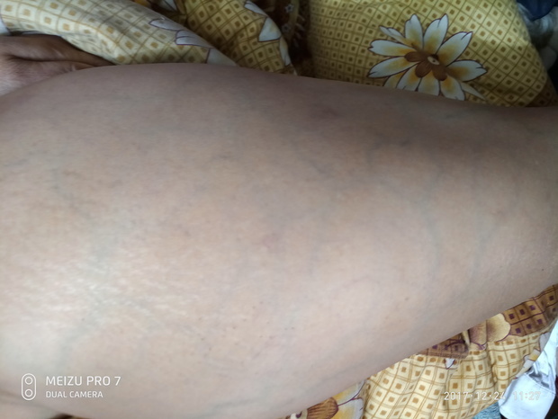 妈妈得了宫颈癌,化疗后有肾积水,腿肿是怎么回