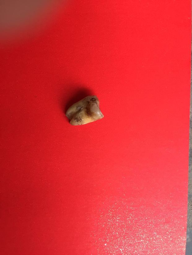 我的大牙掉了不知道是什么原因