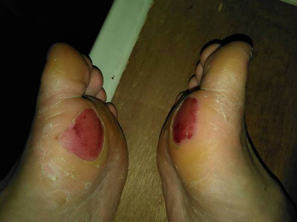 昨晚打球因为鞋子太垃圾了,打球打脚底给搞伤了,请问上什么药好呢?