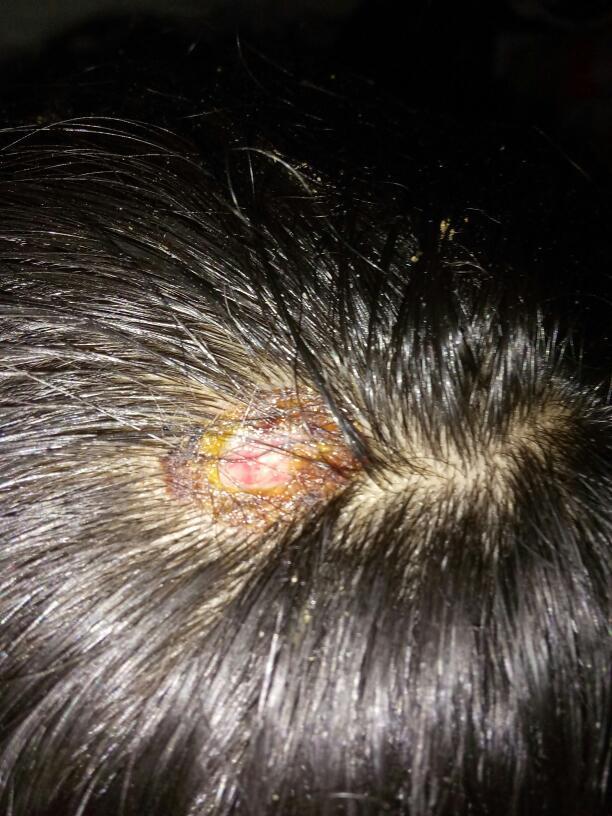 头上做了激光手术,点了肉猴子,目前已经7天左