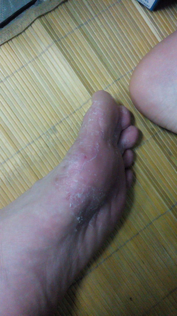 脚长湿疹症状图片图片