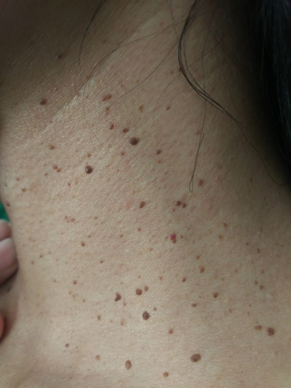 照片上的肉瘤是什么,严重吗?