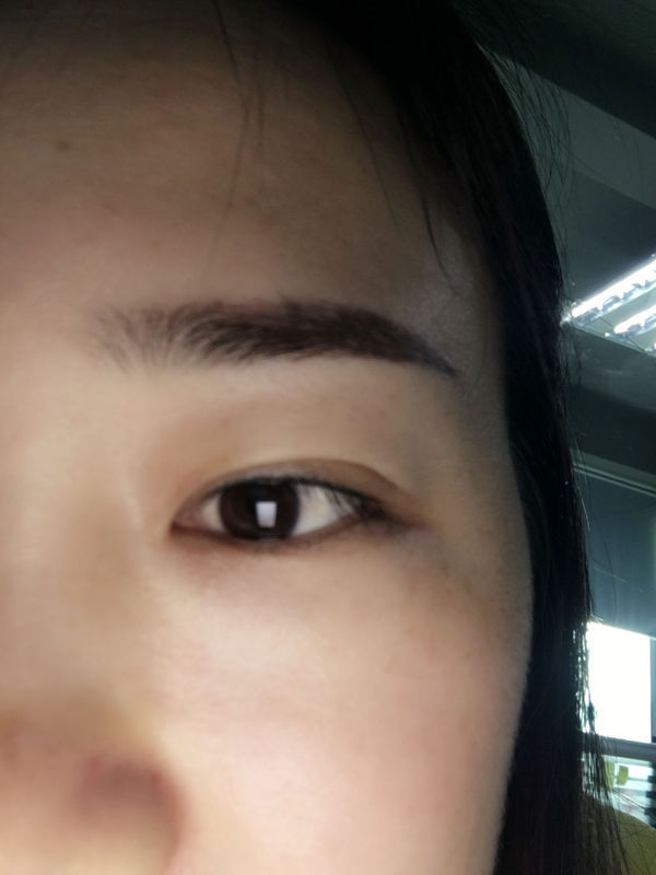 我刚做,结痂还没脱落呢