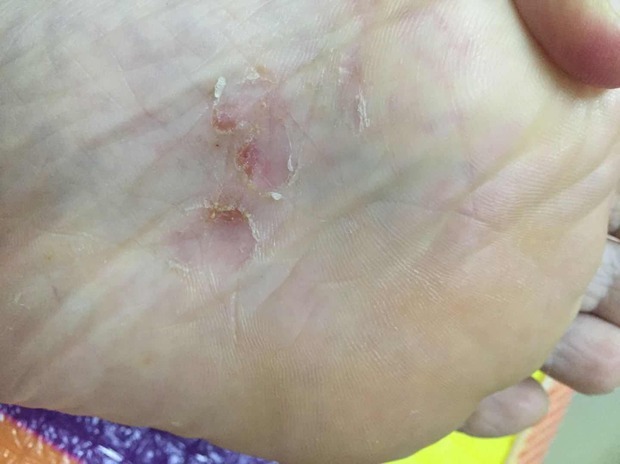 之前穿鞋子不合适脚,加鞋垫挤压到脚掌心,现在