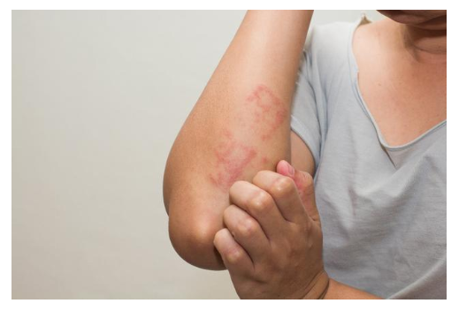 什么叫做食物过敏?