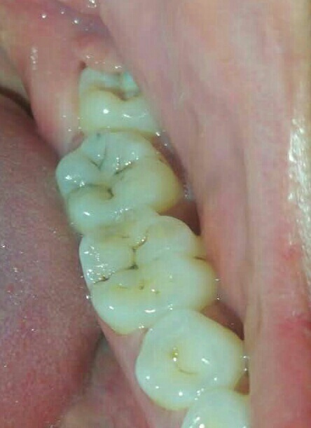 请问这是窝沟龋吗?牙已经坏了吗?