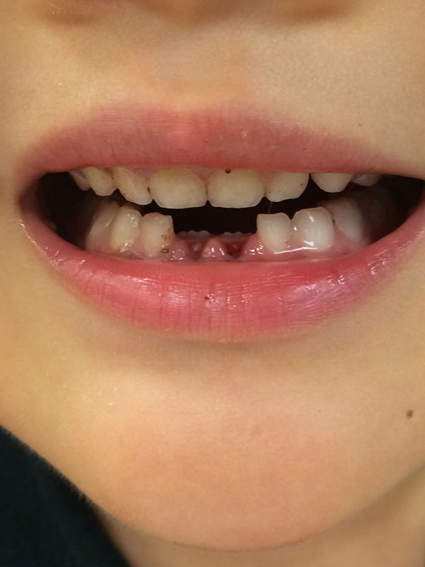 乳牙和恒牙的区别乳牙和恒牙的区别图片