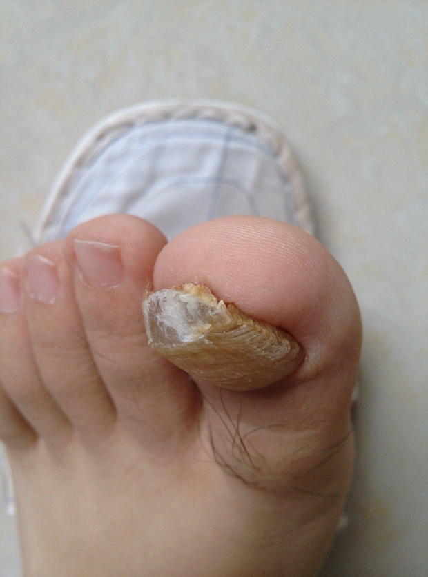 灰指甲的症状 脚上图片