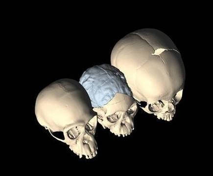 婴儿头骨骨缝闭合时间是多大,额缝