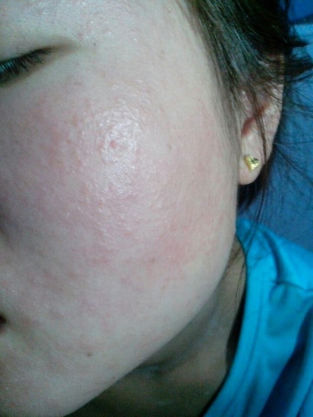 贴面膜过敏红肿怎么办?