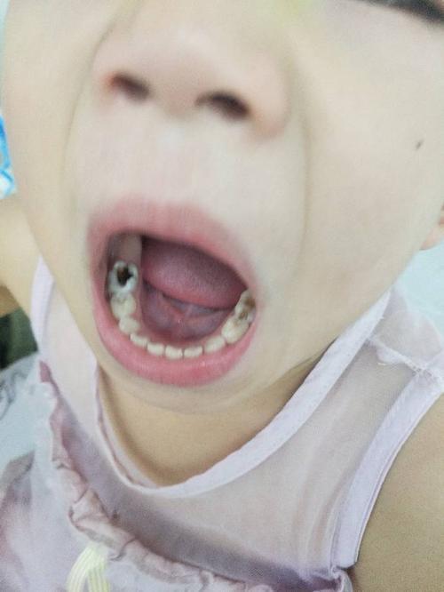 小孩牙齿根部发黑图片图片