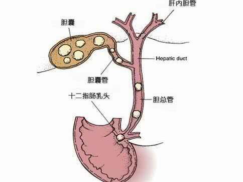 急性胆囊炎严重吗?