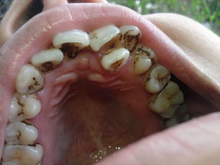 牙齿上边凹槽里的黑色是什么物质,能否