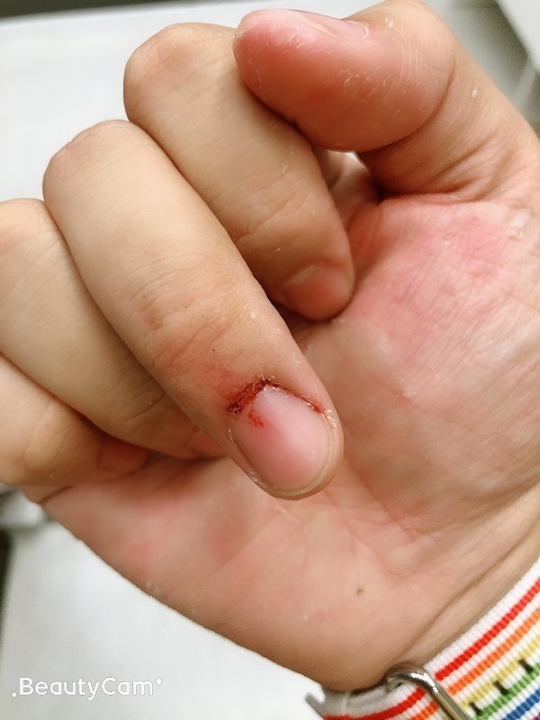 指甲后面的皮肤总是破流血怎么回事?