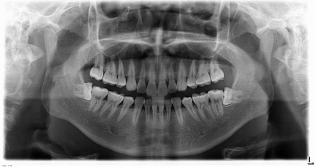 我这两颗智慧牙拔掉的难度大不大?