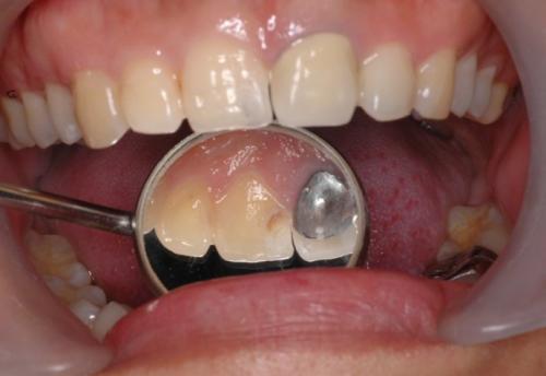 补牙时用的银汞合金有毒吗?