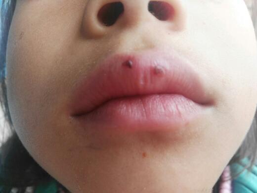 9岁女孩嘴唇长了像湿疹的泡,破了会出水出血