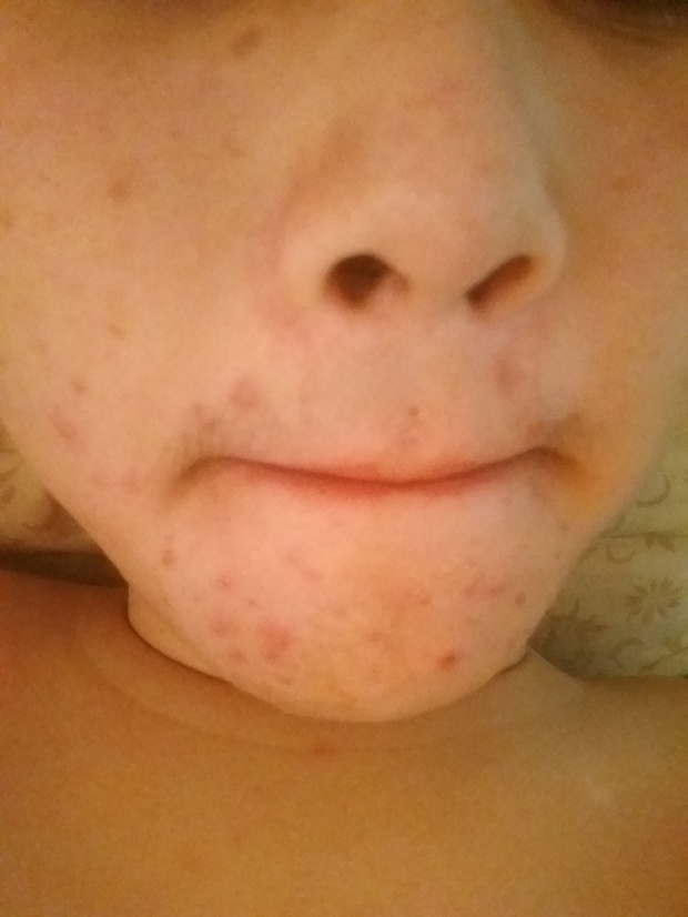 以前不洗脸都不长痘,现在洗脸反而长了很多很