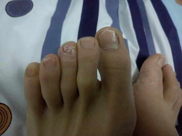 我的脚指甲上有白块是怎么回事?有没有什么异常?