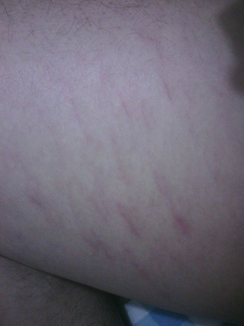 请问一下,在我的大腿内侧有许多红色条纹状的