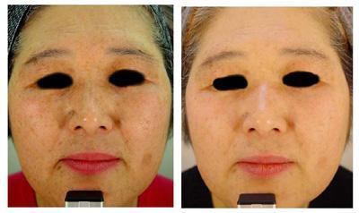 养生堂用醋精去老年斑是哪一期?