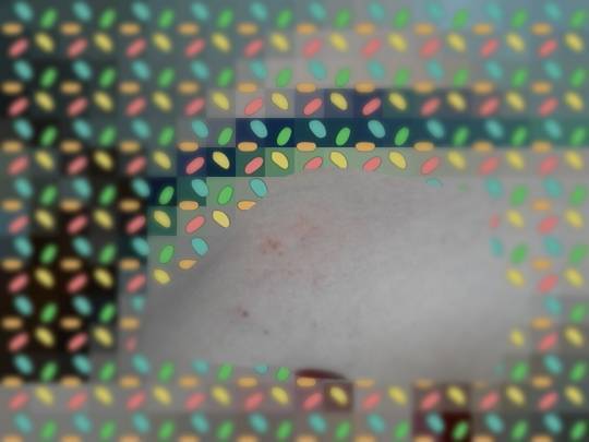 不时起小红点点 经常出现在膝盖窝 靠近腋窝的