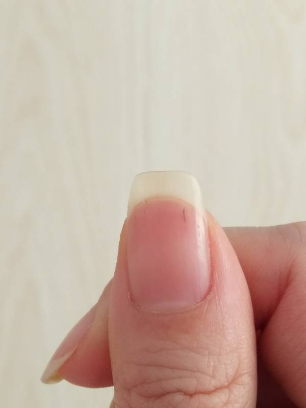 指甲里有一个像是刺的黑线,不疼,这个是什么病吗,以前也有过,剪剪