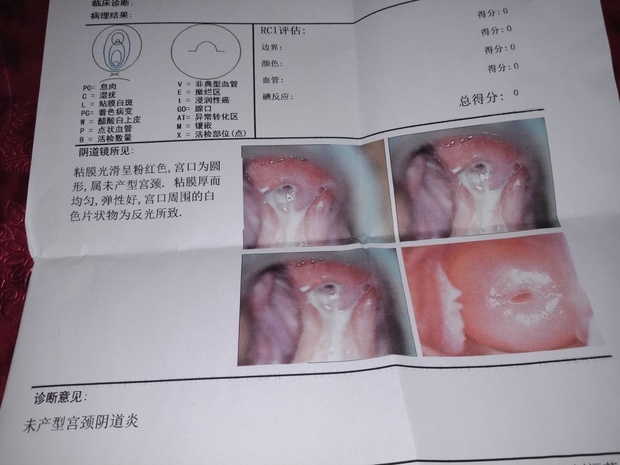 检查出霉菌性阴道炎治疗一个礼拜了感觉炎症好了