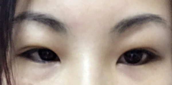 在广东割双眼皮贵吗?大概多少钱?有没有好的