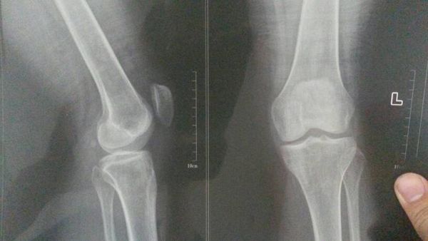 这个膝盖关节X光片有问题吗?医院的病历说一