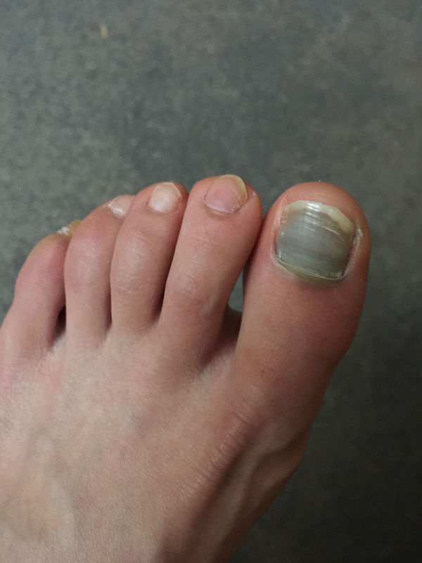 大脚趾指甲跑步后变黑,疼痛感强烈,整个指甲盖