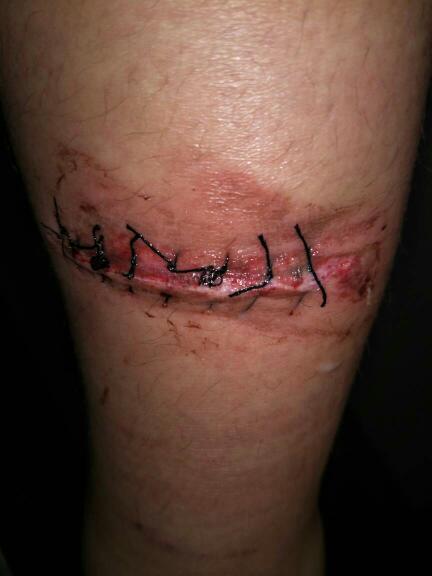 问一下我这个伤口愈合的怎么样?受伤过后的第四天.