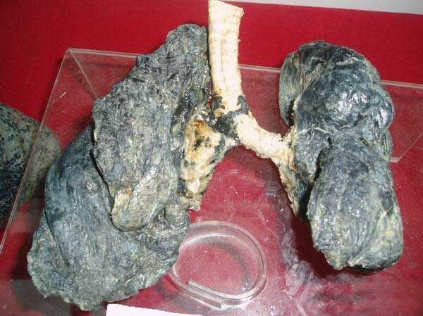 30年吸烟者的肺图片图片