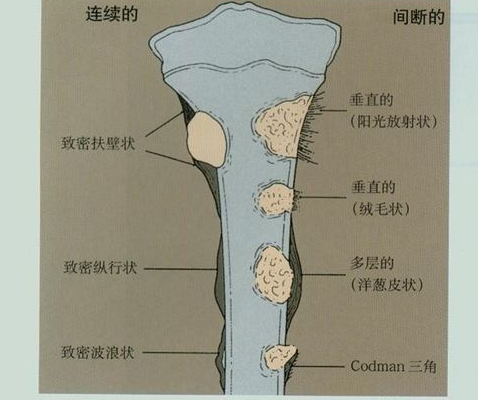 骨膜反应图片图片