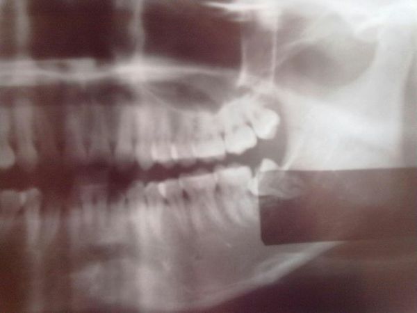 最里面的大牙和牙床(就一般会长智齿那个地方